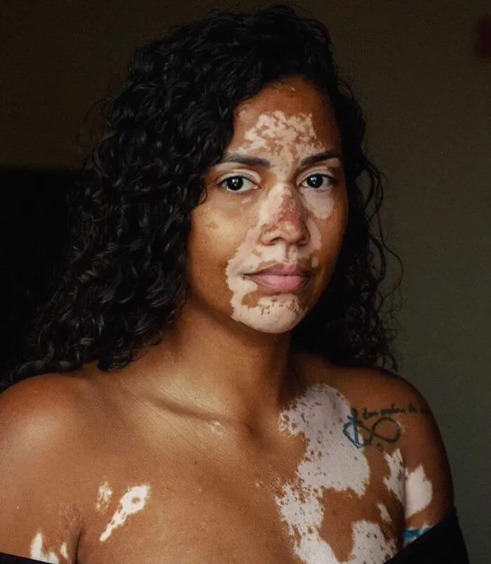 35 Breathtaking Photos Of People With Vitiligo That Redefine What Beauty Looks Like