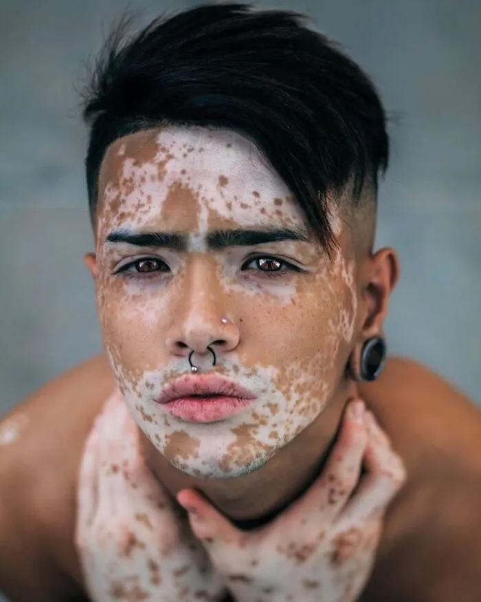 35 Breathtaking Photos Of People With Vitiligo That Redefine What Beauty Looks Like