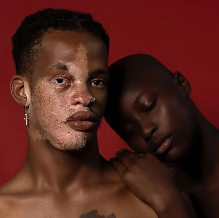 35 Breathtaking Photos Of People With Vitiligo That Redefine What Beauty Looks Like