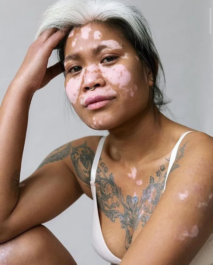 35 Breathtaking Photos Of People With Vitiligo That Redefine What Beauty Looks Like