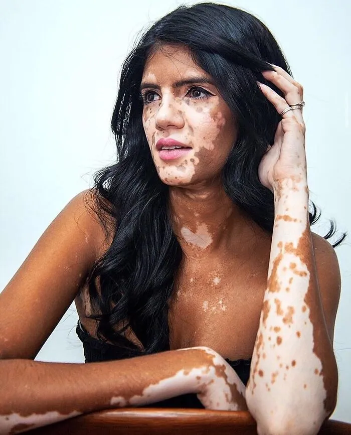 35 Breathtaking Photos Of People With Vitiligo That Redefine What Beauty Looks Like