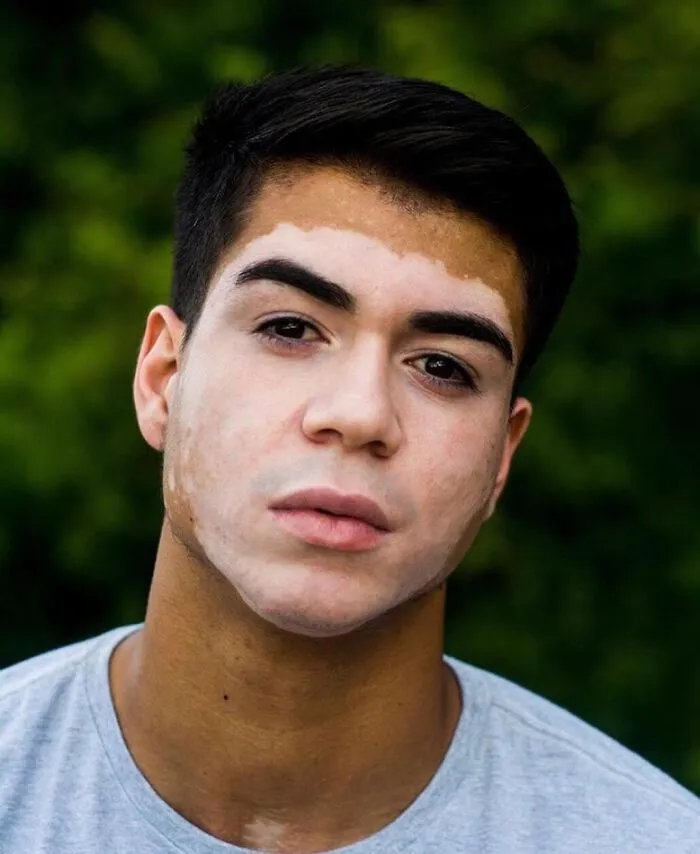35 Breathtaking Photos Of People With Vitiligo That Redefine What Beauty Looks Like