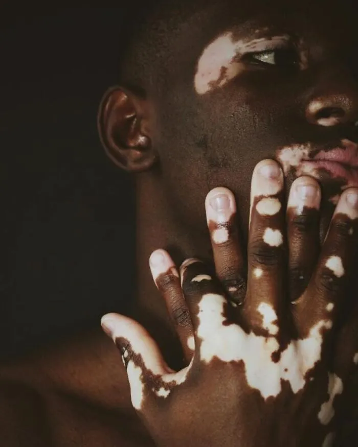 35 Breathtaking Photos Of People With Vitiligo That Redefine What Beauty Looks Like
