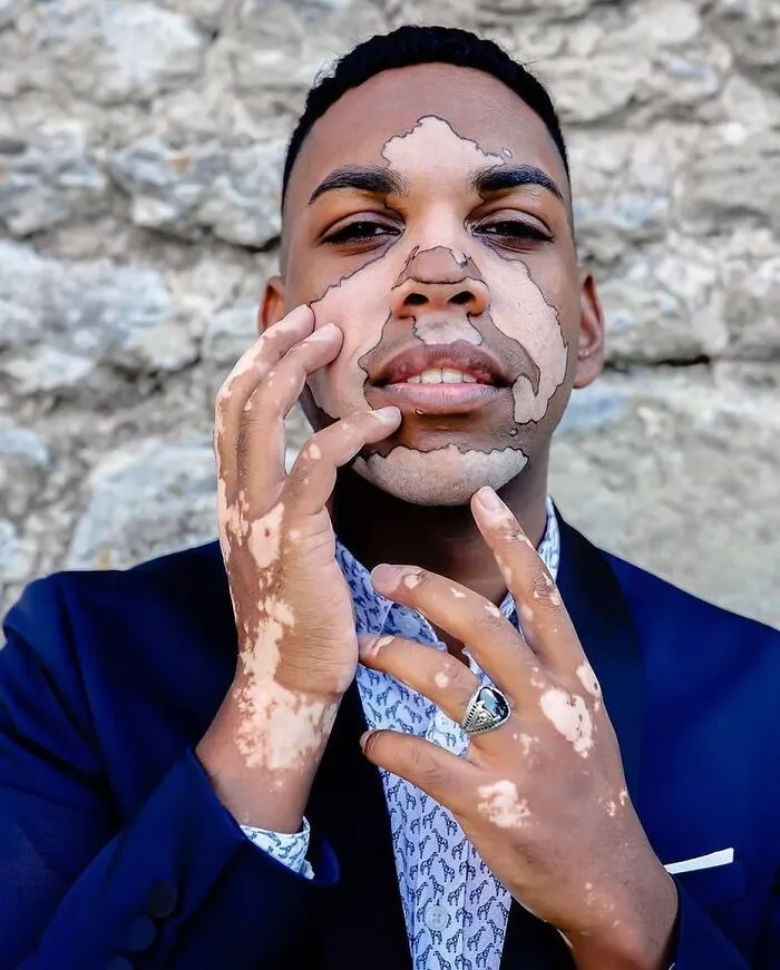 35 Breathtaking Photos Of People With Vitiligo That Redefine What Beauty Looks Like