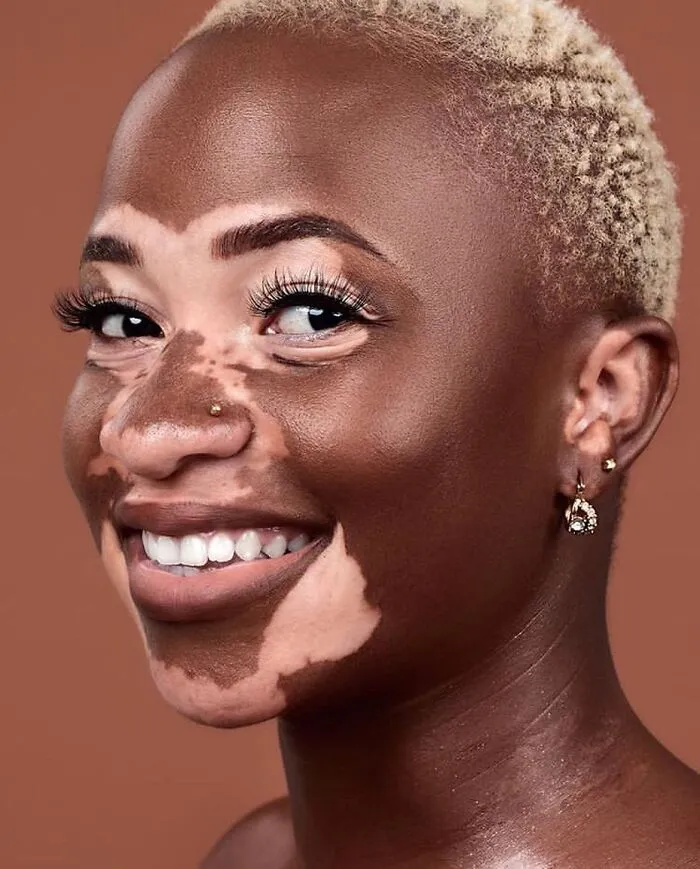 35 Breathtaking Photos Of People With Vitiligo That Redefine What Beauty Looks Like