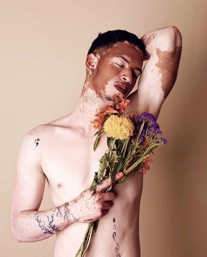 35 Breathtaking Photos Of People With Vitiligo That Redefine What Beauty Looks Like