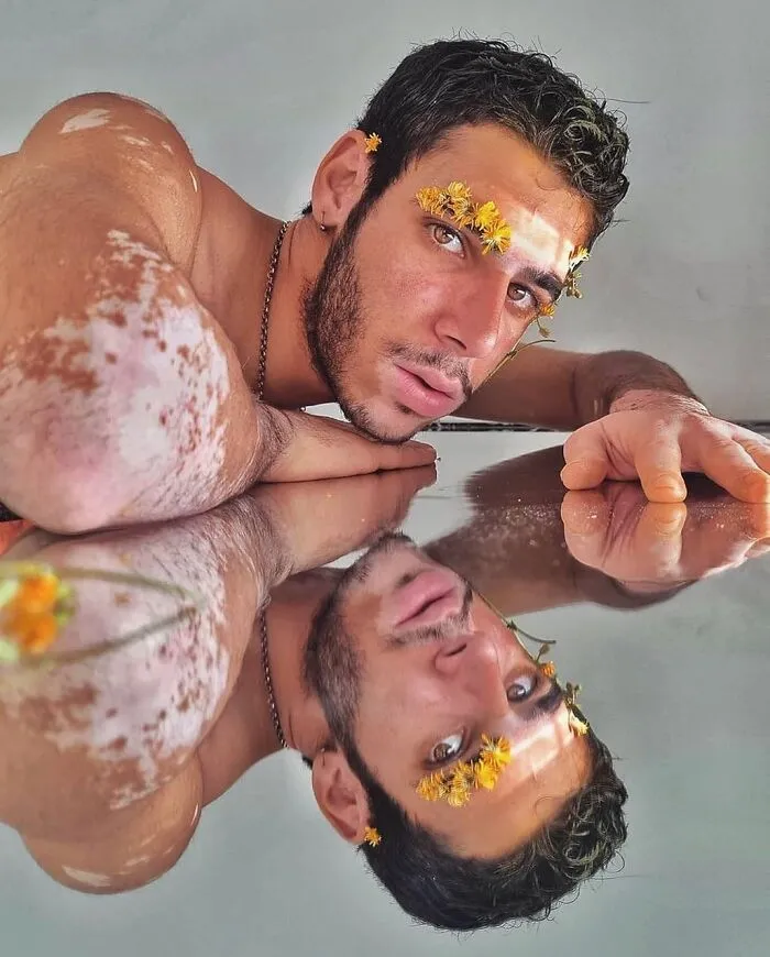 35 Breathtaking Photos Of People With Vitiligo That Redefine What Beauty Looks Like