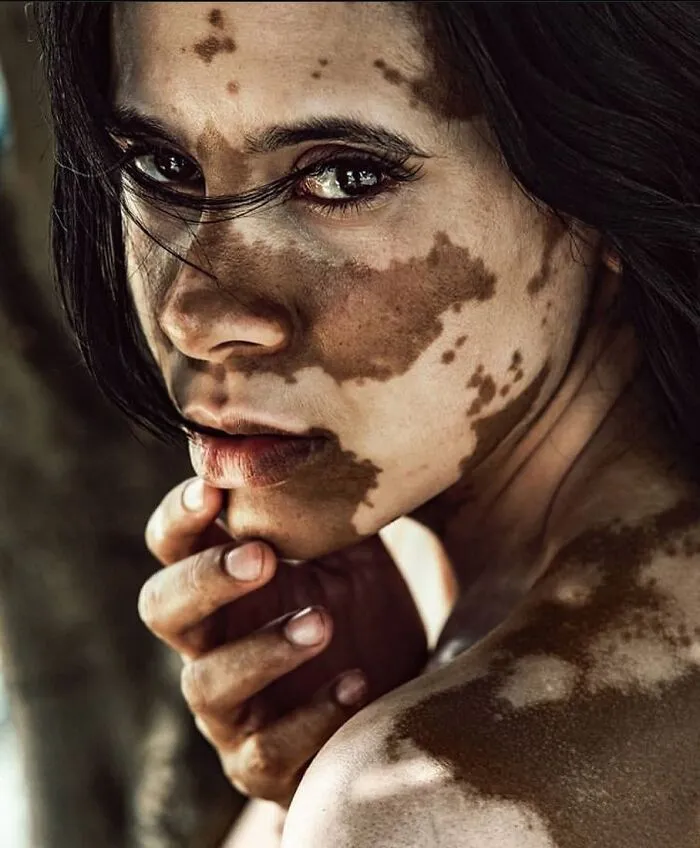 35 Breathtaking Photos Of People With Vitiligo That Redefine What Beauty Looks Like
