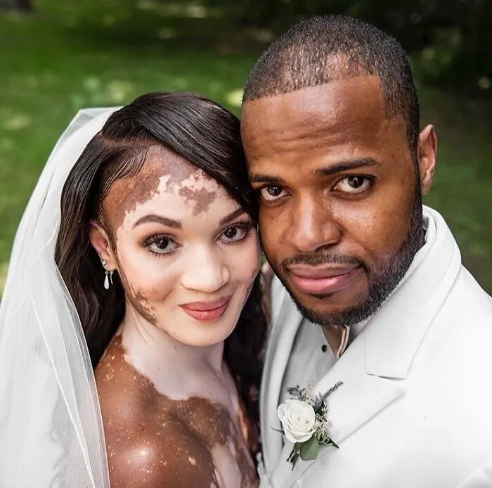 35 Breathtaking Photos Of People With Vitiligo That Redefine What Beauty Looks Like