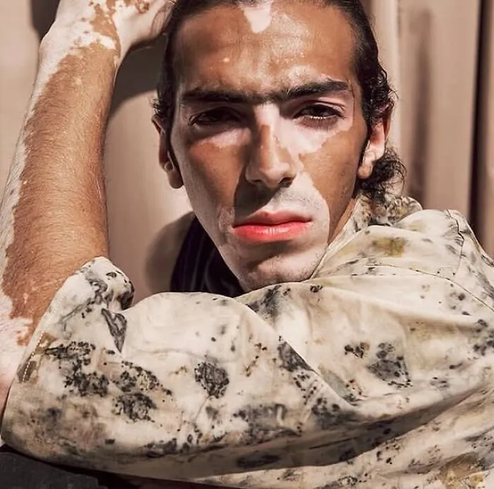 35 Breathtaking Photos Of People With Vitiligo That Redefine What Beauty Looks Like
