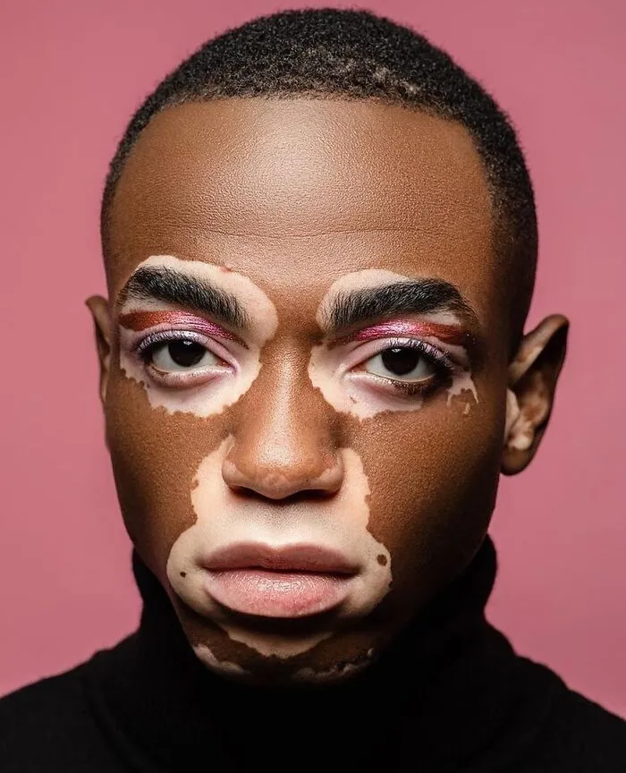 35 Breathtaking Photos Of People With Vitiligo That Redefine What Beauty Looks Like