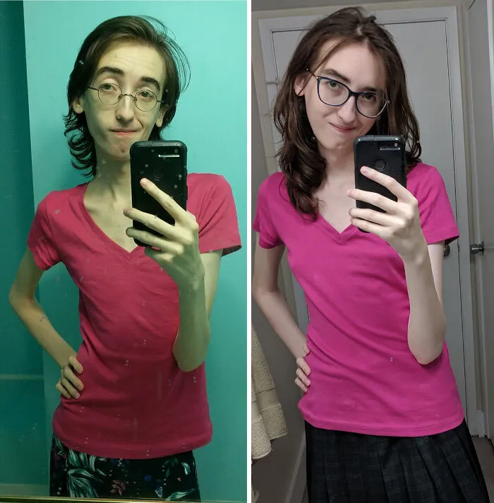 [98 Lbs > 114 Lbs = 16 Lbs Gained] (12 Months) My Marfan Syndrome Keeps Me On The Thin Side, But I Think I Look A Lot Less Sickly Now!