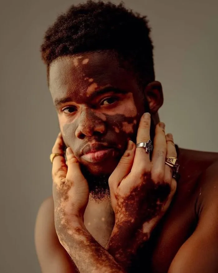 35 Breathtaking Photos Of People With Vitiligo That Redefine What Beauty Looks Like