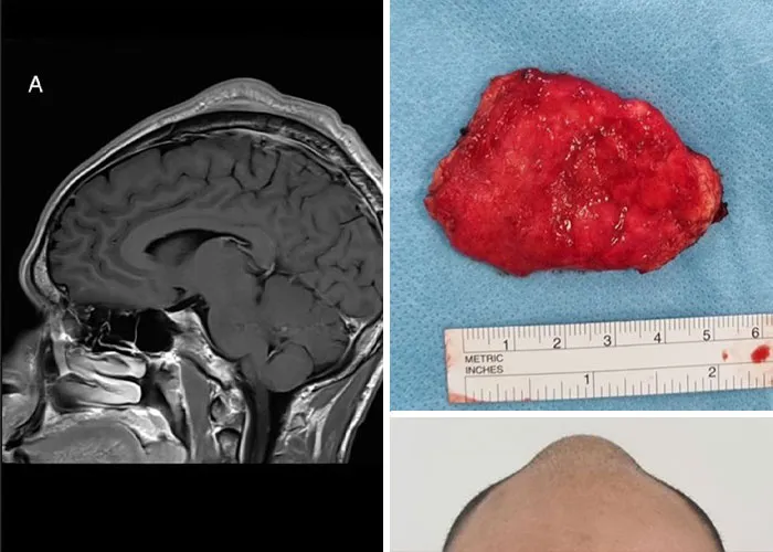 The Breakdancer Who Reshaped His Skull