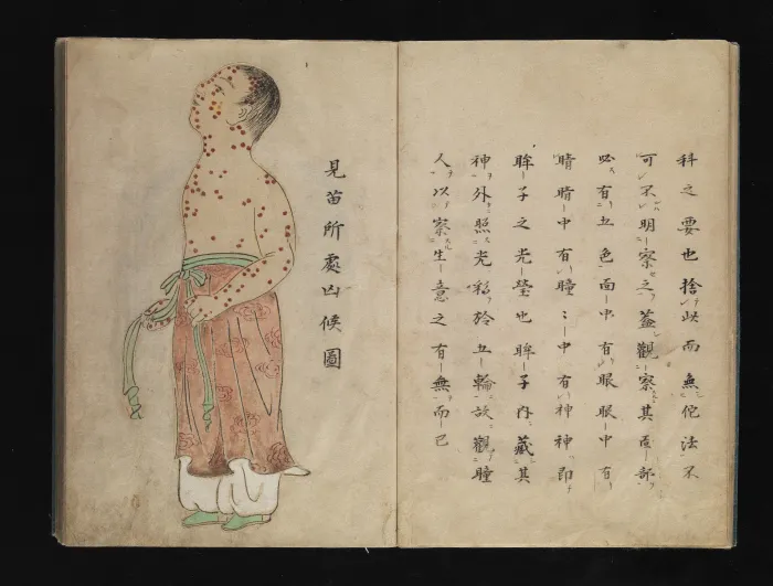 Japanese Smallpox Epidemic, 735-737 Ad