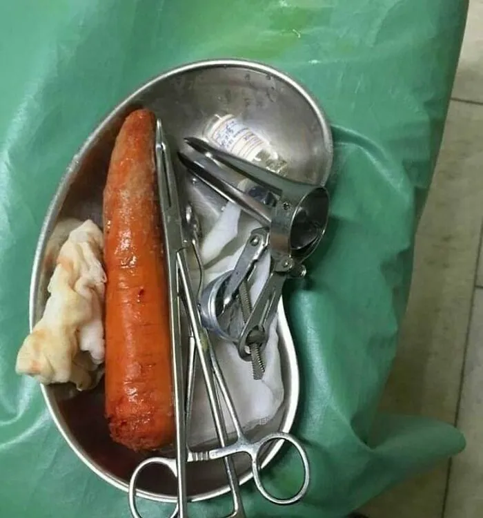 Surgical tools and a large removed object resembling a carrot placed in a metal tray on a green medical cloth.