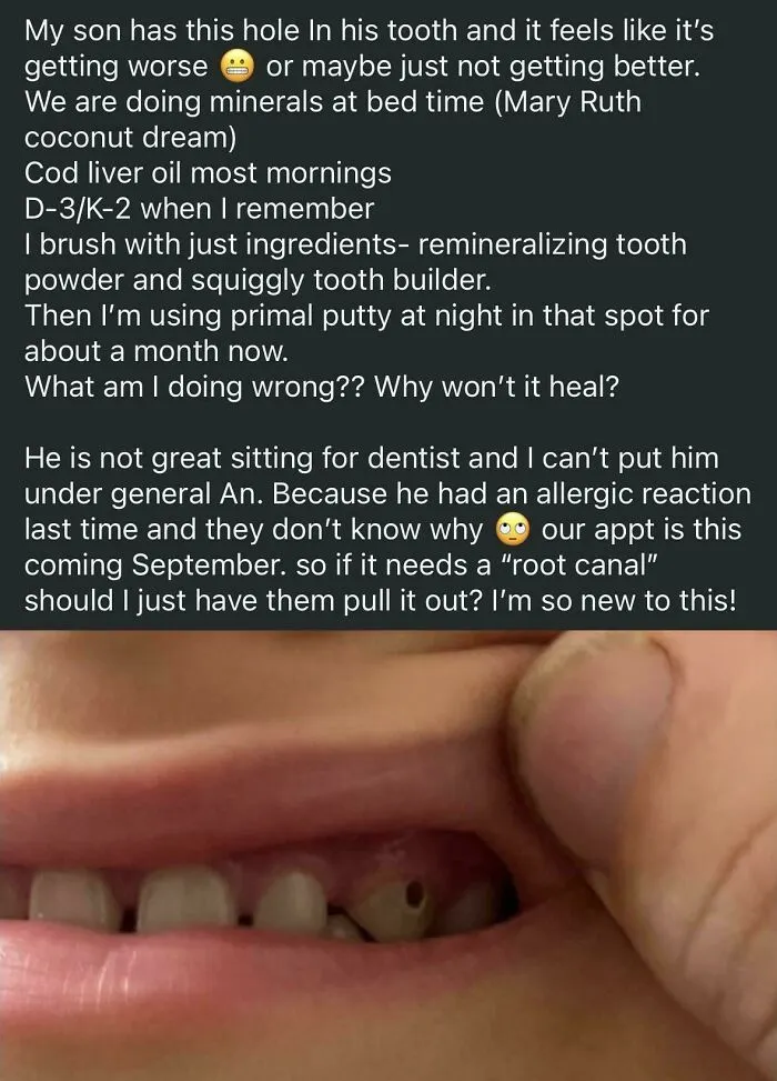 Anything But Fluoride!