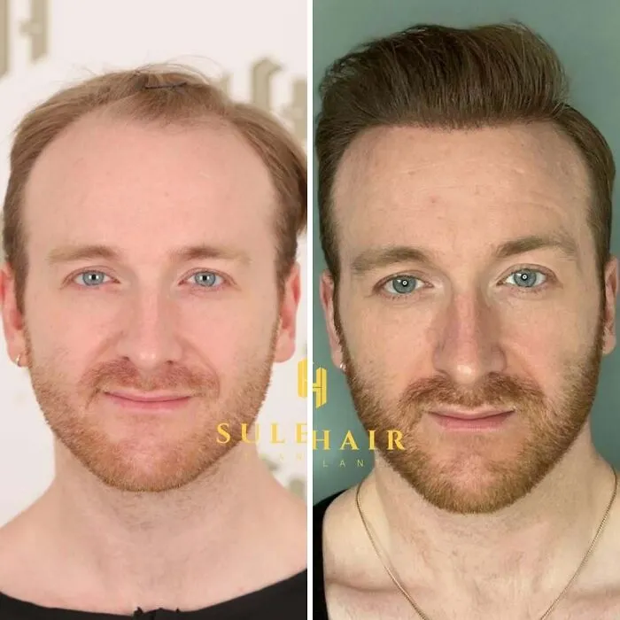 81 Hair Transplant Transformations That Completely Changed These People’s Looks