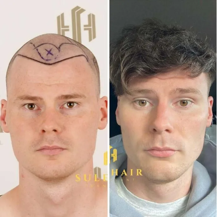 81 Hair Transplant Transformations That Completely Changed These People’s Looks