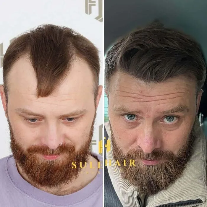 81 Hair Transplant Transformations That Completely Changed These People’s Looks