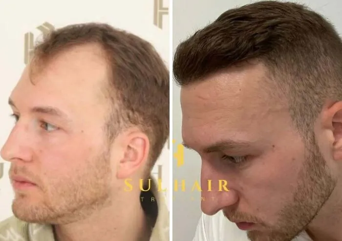 81 Hair Transplant Transformations That Completely Changed These People’s Looks
