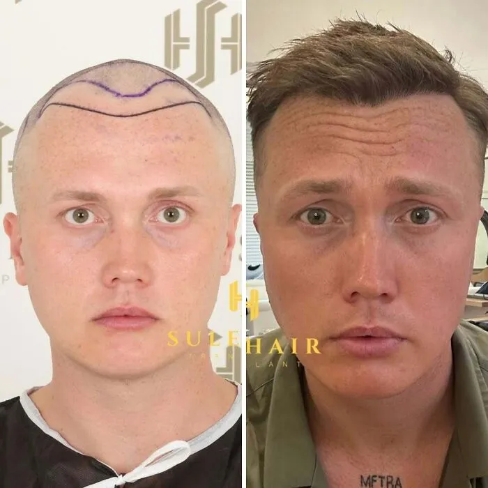 81 Hair Transplant Transformations That Completely Changed These People’s Looks