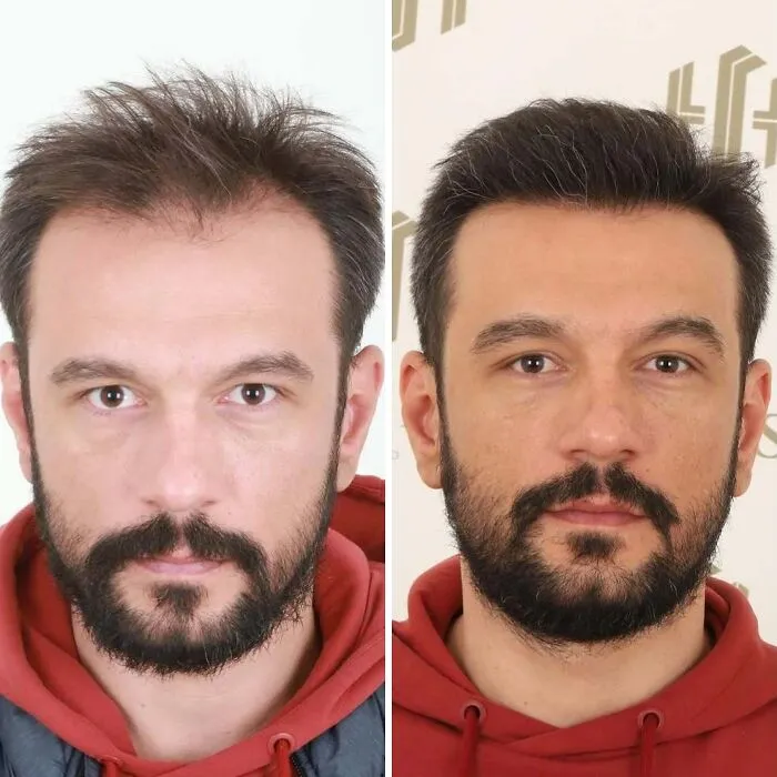 81 Hair Transplant Transformations That Completely Changed These People’s Looks