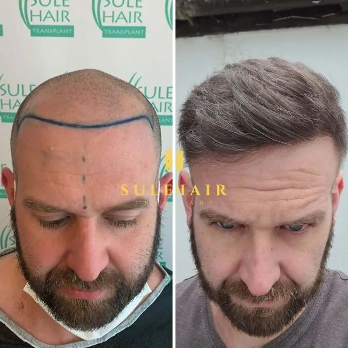 81 Hair Transplant Transformations That Completely Changed These People’s Looks