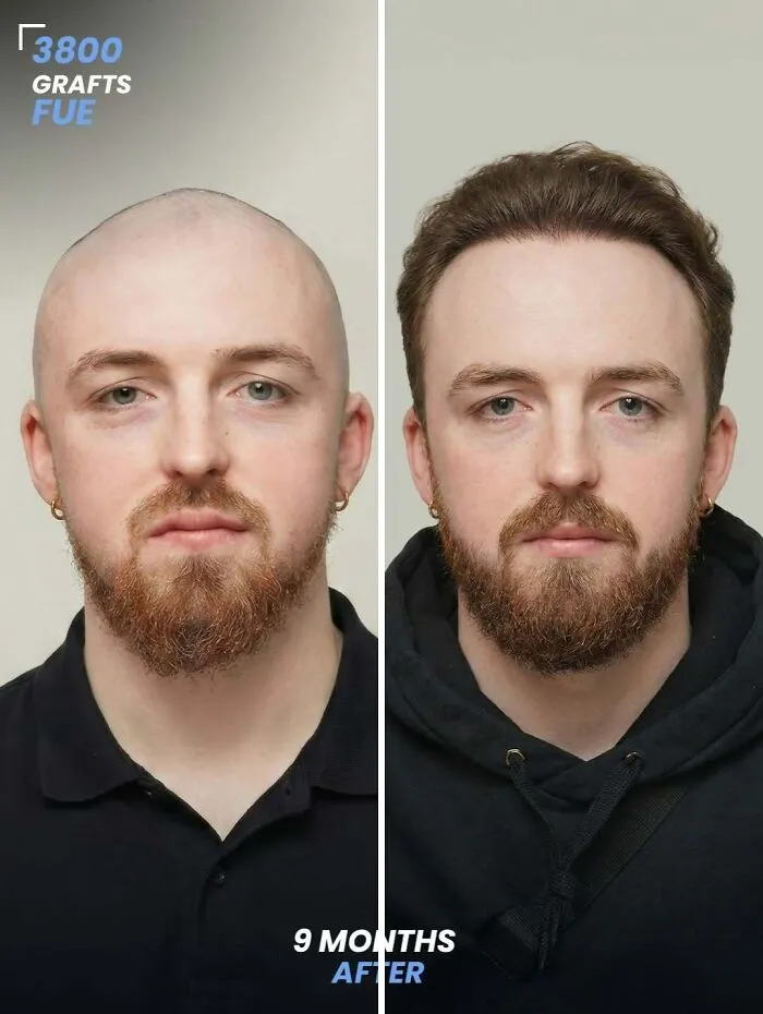 81 Hair Transplant Transformations That Completely Changed These People’s Looks
