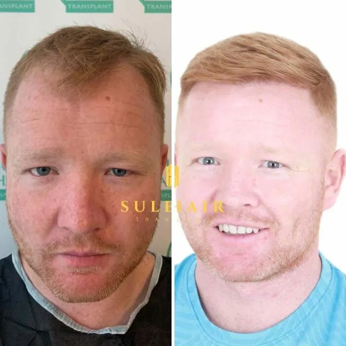 81 Hair Transplant Transformations That Completely Changed These People’s Looks