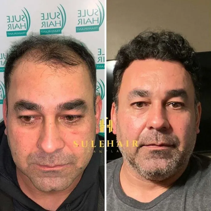 81 Hair Transplant Transformations That Completely Changed These People’s Looks
