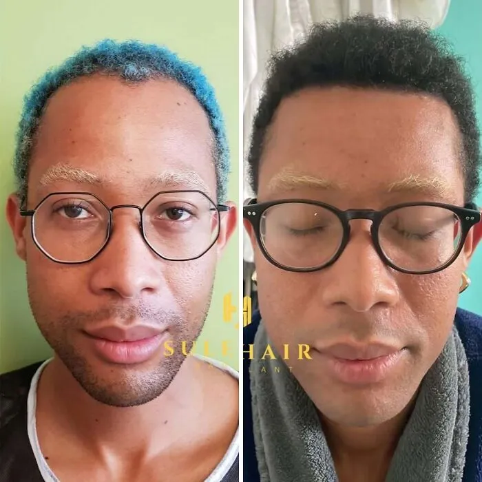 81 Hair Transplant Transformations That Completely Changed These People’s Looks