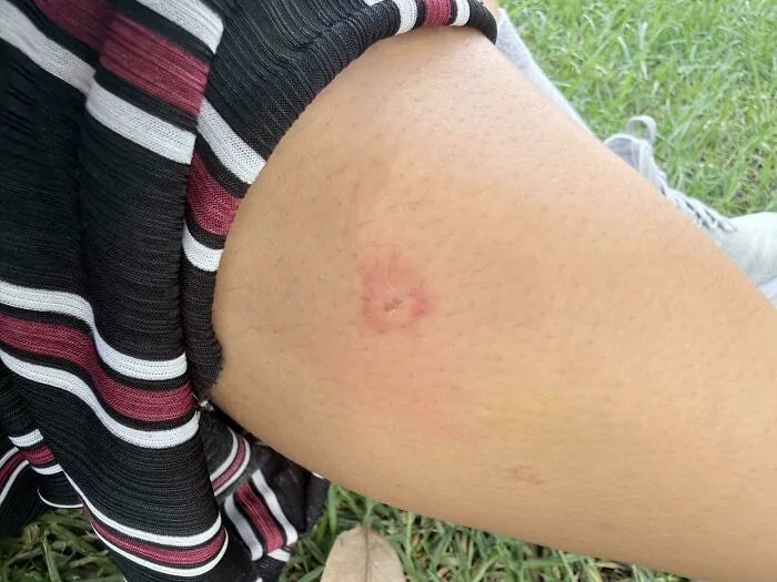 What Bit Me? It’s Itchy