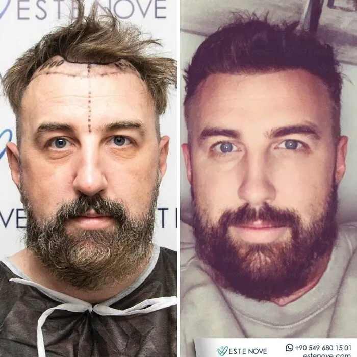 81 Hair Transplant Transformations That Completely Changed These People’s Looks