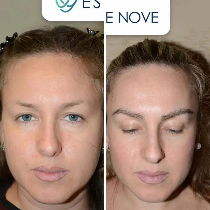 81 Hair Transplant Transformations That Completely Changed These People’s Looks