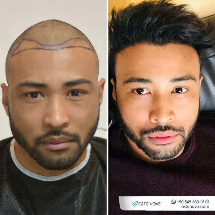 81 Hair Transplant Transformations That Completely Changed These People’s Looks