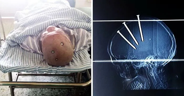This Man Has Miraculously Survived After Apparently Hammering Three 10cm (4-Inch) Nails Into His Own Head