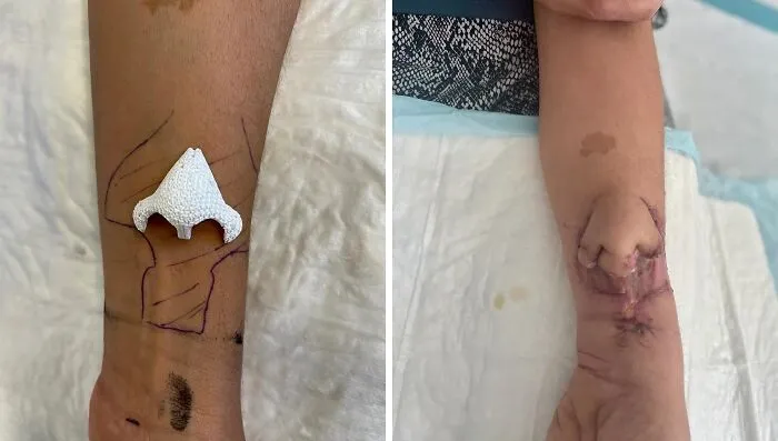 Doctors Successfully 3D Printed This Cancer Patient A New Nose, Planted It On His Forearm To Then Re-Implant It Where It Belongs