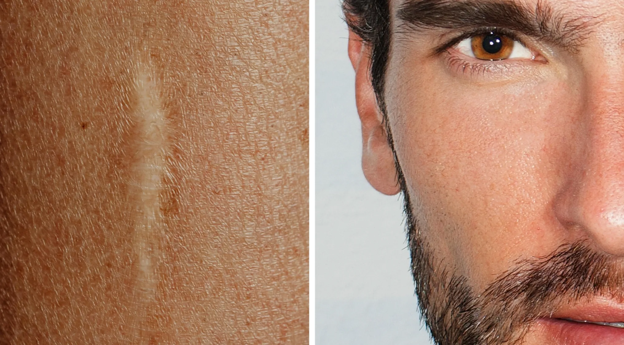 Close-up of scarred skin and part of a man's face with beard, related to movies and TV shows visual hints.