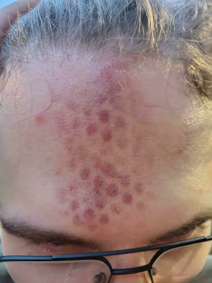 Este hematoma en la frente de mi amiga después de golpearse contra un altavoz