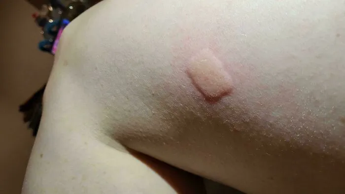 Esta reacción rectangular a la picadura de un mosquito en mi pierna