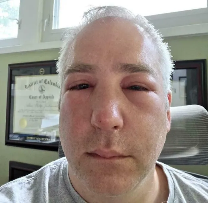Me picó una abeja en la nariz y ahora parezco que perdí un combate de boxeo.