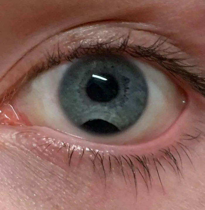 Una foto de cerca de mi ojo. Tuve desprendimiento de retina. Así se veía después de la cirugía.