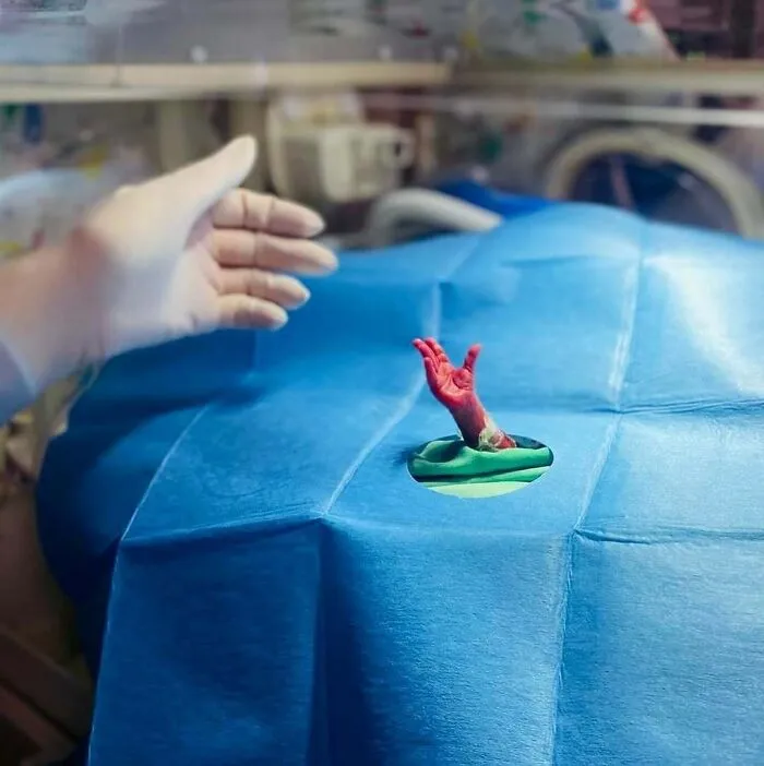 Reaching For Life! This Image Depicts A Deeply Moving Moment Of A Preterm Baby, Born At Just 24 Weeks Gestation And Weighing 570 Grams