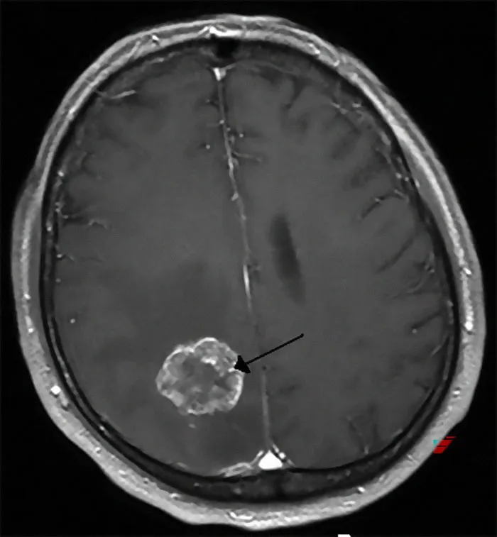 MIL Says My Tumor Is Fake