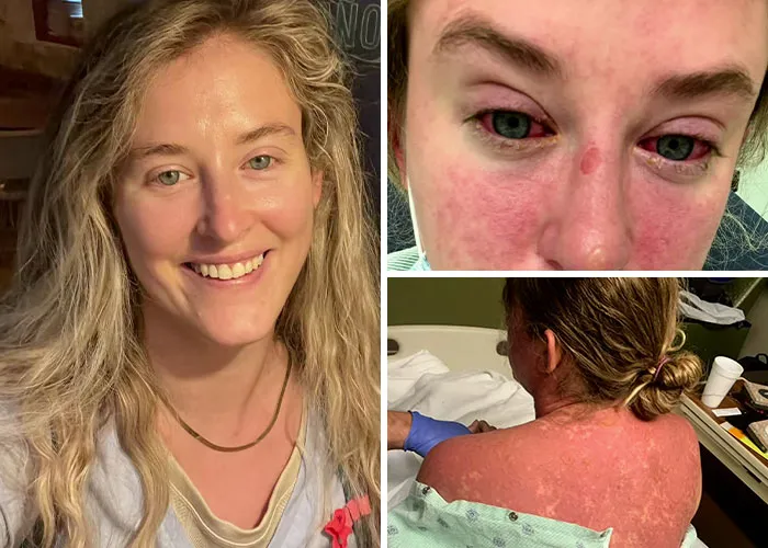 “I Started To Resemble A Zombie”: The Illness That Took Over Her Body