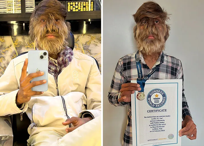 The Teen With The World’s Hairiest Face