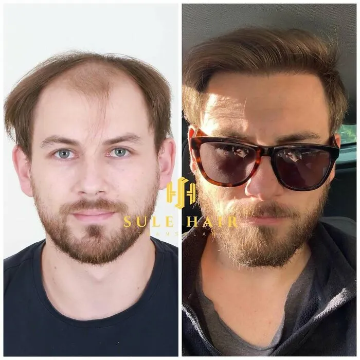 81 Hair Transplant Transformations That Completely Changed These People’s Looks