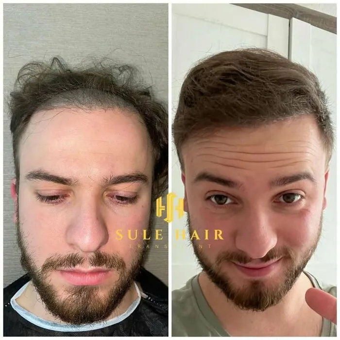 81 Hair Transplant Transformations That Completely Changed These People’s Looks