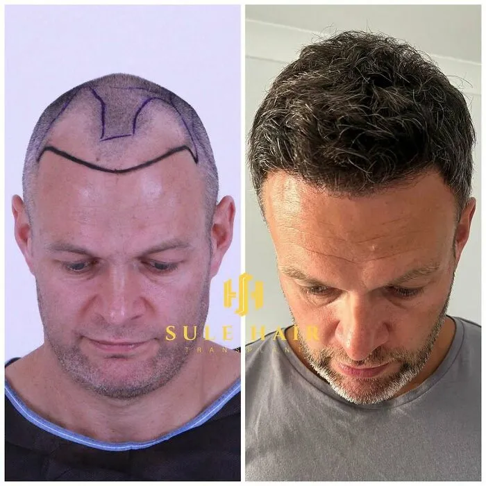 81 Hair Transplant Transformations That Completely Changed These People’s Looks